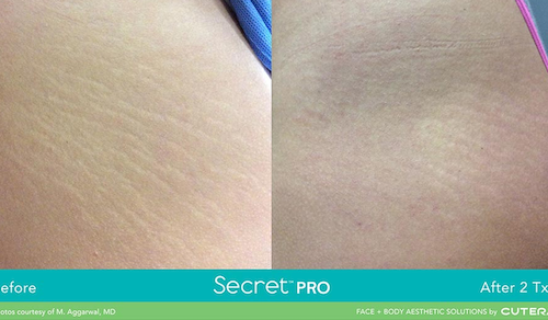 stretch mark removal before after mississauga oakville